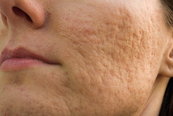 Acne Scars - Dermatology On Bloor