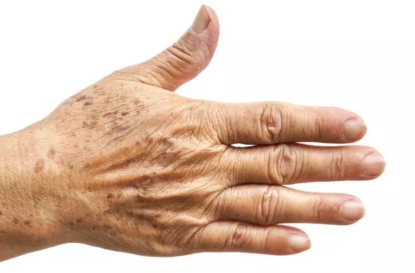 Aging Hands - Treatment