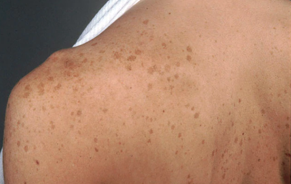 Brown Spots - Hyperpigmentation