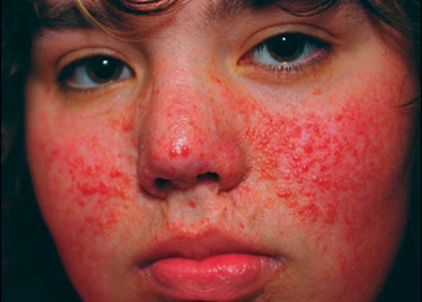 Rosacea