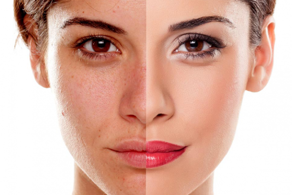 Tired or Dull Complexion – Dermatology on Bloor