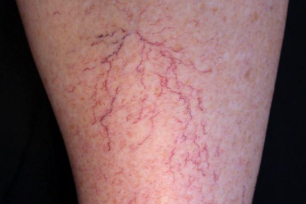 Leg Veins - Dermatology on Bloor